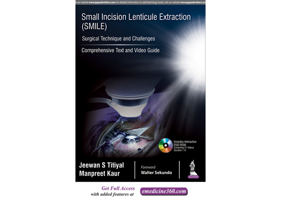 Small Incision Lenticule Extraction (SMILE): Surgi