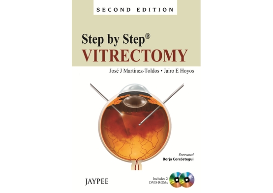 Step by Step: Vitrectomy