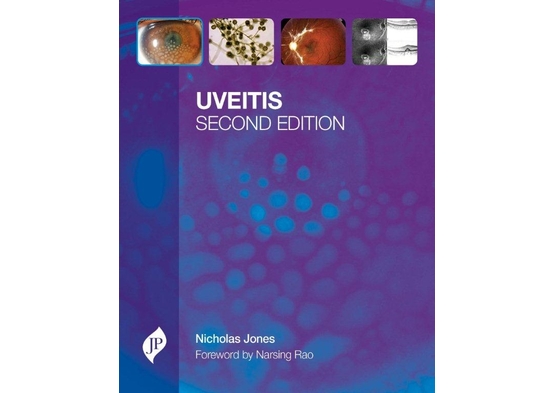 Uveitis