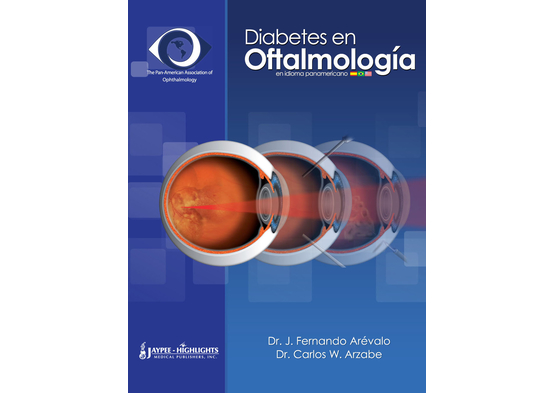 Diabetes en Oftalmología